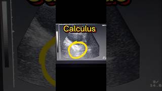 Bladder Stone  Vesical Stone  Vesicle Calculus  Cystitis  UTI ultrasound [upl. by Ahsiakal]