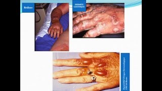 DERMATOLOGIE Conduite à Tenir devant une Bullose [upl. by Utimer408]