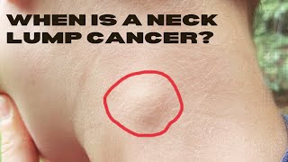 Could My Neck Lump Be Cancer Such as Lymphoma [upl. by Pinckney]