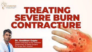 Dr Anubhav Gupta on Burn Contracture Surgical Treatment and Recovery [upl. by Vaclava]