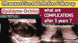 Chronic Scrotal Infection  Complications  Male Infertility  Epididymo Orchitis [upl. by Gereld]