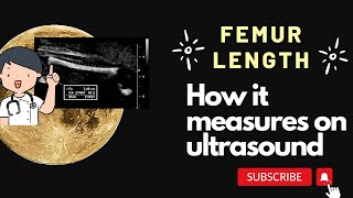 What is Femur length why it is important to measure on ultrasound how it is measure [upl. by Enahsed]