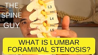 What is Lumbar Foraminal Stenosis [upl. by Ellesij716]