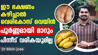 ഈ ഭക്ഷണങ്ങൾ കഴിച്ചു വെരികോസ് വെയ്ൻ പൂർണമായി മാറ്റം Vericose Treatment in Malayalam Dr Bibin Jose [upl. by Lux]