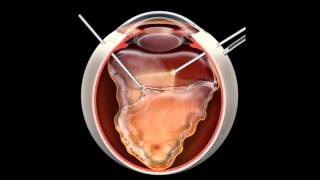 Retinal Detachment  Signs Symptoms and Treatment [upl. by Eylatan]