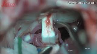 Microvascular Decompression for Left Hemifacial Spasm [upl. by Breh]