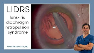 LIDRS lensiris diaphragm retropulsion syndrome Explanation and Demonstration [upl. by Charissa291]