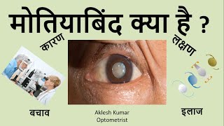 Cataract  Cataract Symptoms  Cataract Causes  Cataract Treatment  cataract surgery  Hindi Me [upl. by Eenar]