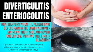 Diverticulitis ultrasound  colitis ultrasound  Bowel ultrasound  abdominal ultrasound  Appendix [upl. by Stelu288]