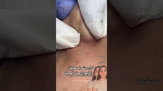 laser hair removal laser hair removal at home la 7 [upl. by Maite61]