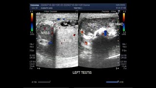 Ultrasound Video showing Epididymoorchitis Pyocele with septation Scrotal and Epididymal mass [upl. by Beekman]