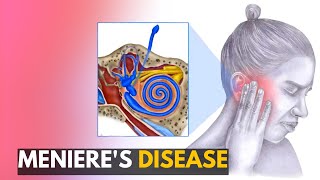 Menieres disease Everything You Need to Know [upl. by Ellednahs]