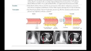 Pleural effusion 2 Physical findings in lung diseases Parapneumonic effusions  Respiratory  11 [upl. by Savina]