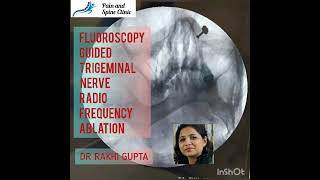 Fluoroscopy guided trigeminal nerve radiofrequency ablation for trigeminal neuralgia Dr Rakhi Gupta [upl. by Akirat819]