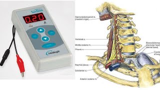 Supraclavicular brachial plexus block  nerve stimulator guided [upl. by Aneerhs537]