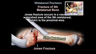 Metatarsal Fractures  Everything You Need To Know  Dr Nabil Ebraheim [upl. by Persis]