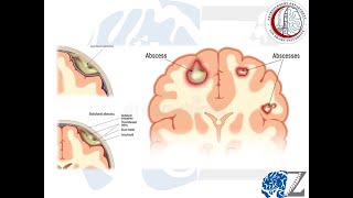 CNS Infection 1  Brain Abscess 1 خُراج بالمخ [upl. by Htebsil82]