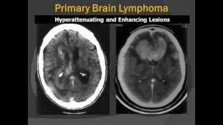 Corpus Callosum Primary CNS Lymphoma PCNSL RadiologicPathologic Correlation [upl. by Arikahc]