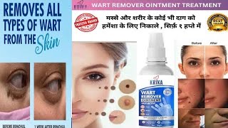 Wart Remover Ointment reviews  Does wart removal really work  Massa kaise hataye  Honest Review [upl. by Ttereve]