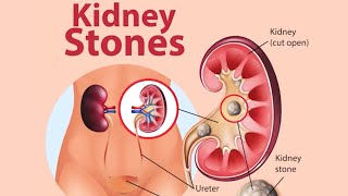 what are causes of kidney stones   Dr JANANI [upl. by Ycak]