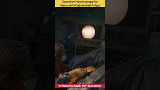 Operative Hysteroscopy for Uterus with Endometrial Polyps by Dr Rakshita Malik doctor mbbs ivf [upl. by Ardnossak4]