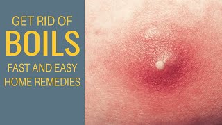 Get Rid Of Boils Fast At Home  Remedies For Boils [upl. by Camille]