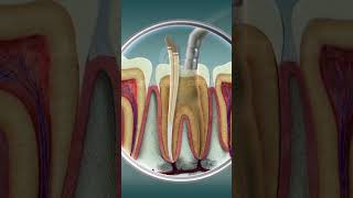 Root Canal Treatment  Curveia Dental I RCT [upl. by Whitson]