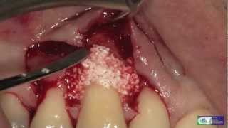 Single Flap Approach for soft and hard tissue reconstruction [upl. by Fredie420]