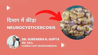 What is neurocysticercosis  Tapeworm  How it spreads  Treatments [upl. by Lavud]