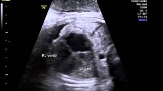 Dilated cardiomyopathy with associated MR and TR in fetus [upl. by Aneerol]