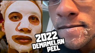 Dermamelan Peel 2022 Chemcial Peel for Severe hyperpigmentation [upl. by Nuahs]