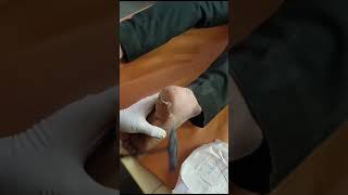 Calcaneal Spur Heel Spur Ayurvedic Treatment Through Agnikarma  वात कंटक [upl. by Joachim496]