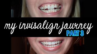 My Invisalign Journey PART 3  Finishing Up The Invisalign Process  Results  Vivera Retainers [upl. by Ladew]