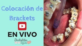 COLOCACIÓN DE BRACKETS EN VIVO  Apiñamiento Superior e inferior [upl. by Eserahc]