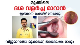 മുക്കിലെ ദശ മാറാൻ  Nasal Polyps Malayalam  Arogyam  Dr Fasi Mohammed [upl. by Bigod]