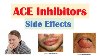 ACE Inhibitor Side Effects Lisinopril Ramipril Captopril Perindopril  Causes and Why They Occur [upl. by Ketty]