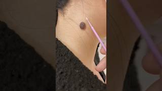 medical human skin problem anatomy eczema dermatitis chickenpox measles ringworm [upl. by Rammaj977]