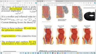 Haemorrhoids Clinical Pharmacy [upl. by Eissak]