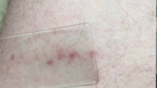 Glass test  Meningitis rash [upl. by Lanni]