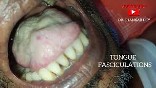 Tongue Fasciculations  Motor Neuron Disease  Amyotrophic Lateral Sclerosis  Dr Shankar Dey [upl. by Eckblad]