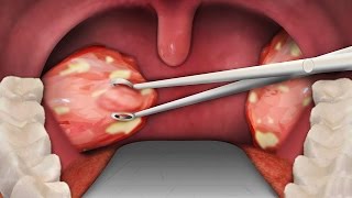 TONSIL REMOVAL SURGERY  Tonsillectomy Surgery [upl. by Noellyn329]