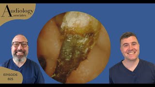 MASSIVE ECZEMA EAR WAX REMOVAL amp DIFFICULT DEEP EAR WAX PLUGS  EP825 [upl. by Uela992]