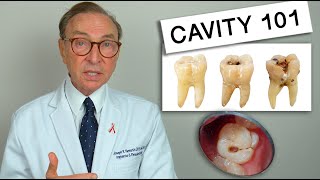 What Causes Tooth Decay Cavity 101  Causes  Treatment [upl. by Bury]