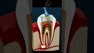 DİŞLERDE Kanal tedavisi science teknoloji bilim [upl. by Falkner]