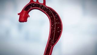 Animation of Aortic Aneurysm Stenting [upl. by Spatola941]