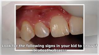 Abscessed Tooth In Child  Causes Symptoms And Treatment [upl. by Eiznek]