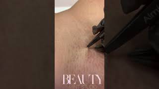 Ingrown Hair Removal [upl. by Karolyn]