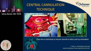 VA ECMO With Peripheral Cannulation LV Failure Aditya Bansal MD FACS [upl. by Hodge]