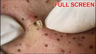 Blackheads Removal  Best Pimple Popping Videos [upl. by Morgenthaler88]