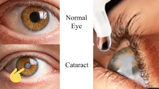 The 1 Remedy for Cataracts [upl. by Aidnyl]